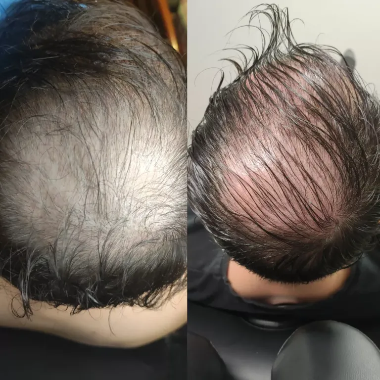 Ejemplo de tratamiento contra la alopecia. Comparación antes y después